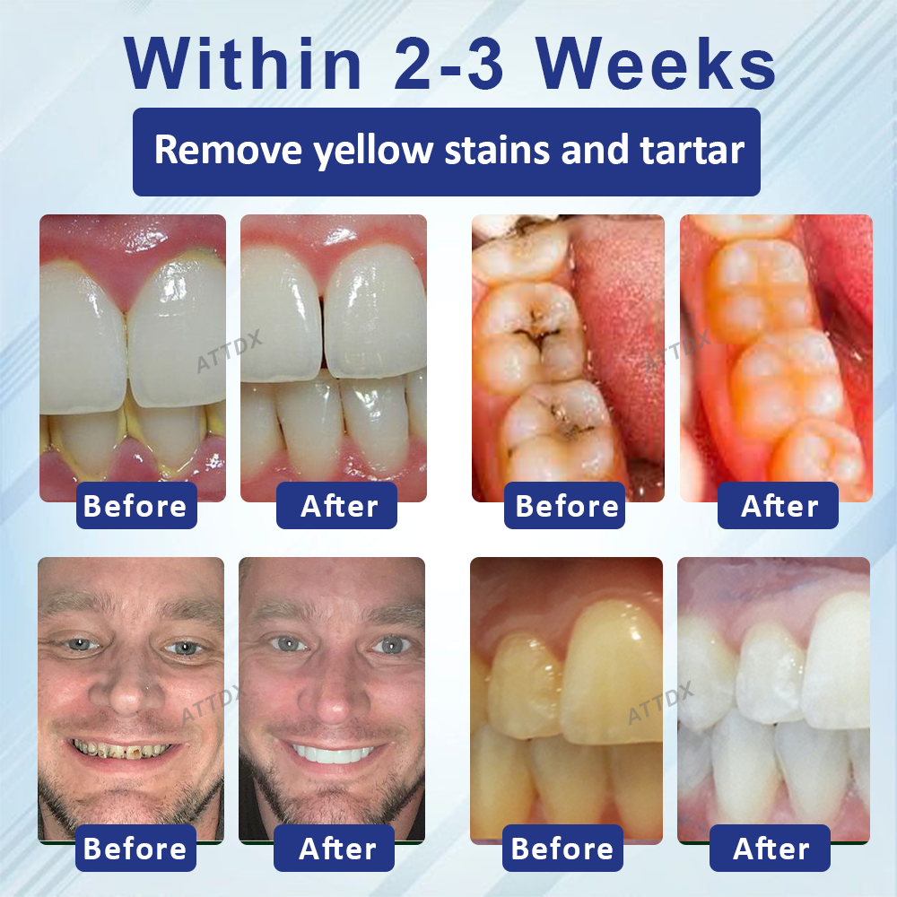 ATTDX™ Concentrated Mellifera Venom Mouth Care Toothpaste