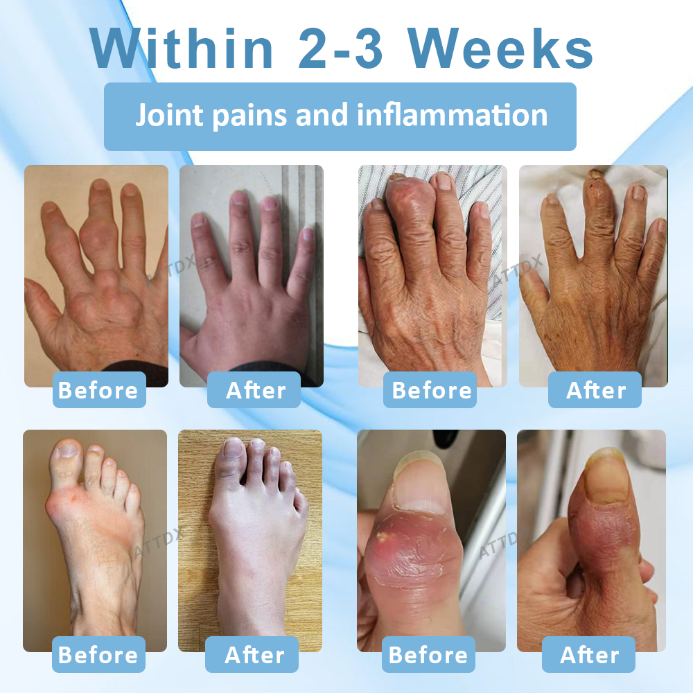 ATTDX™ Gout Soothe Herbal Joint Relief Patch