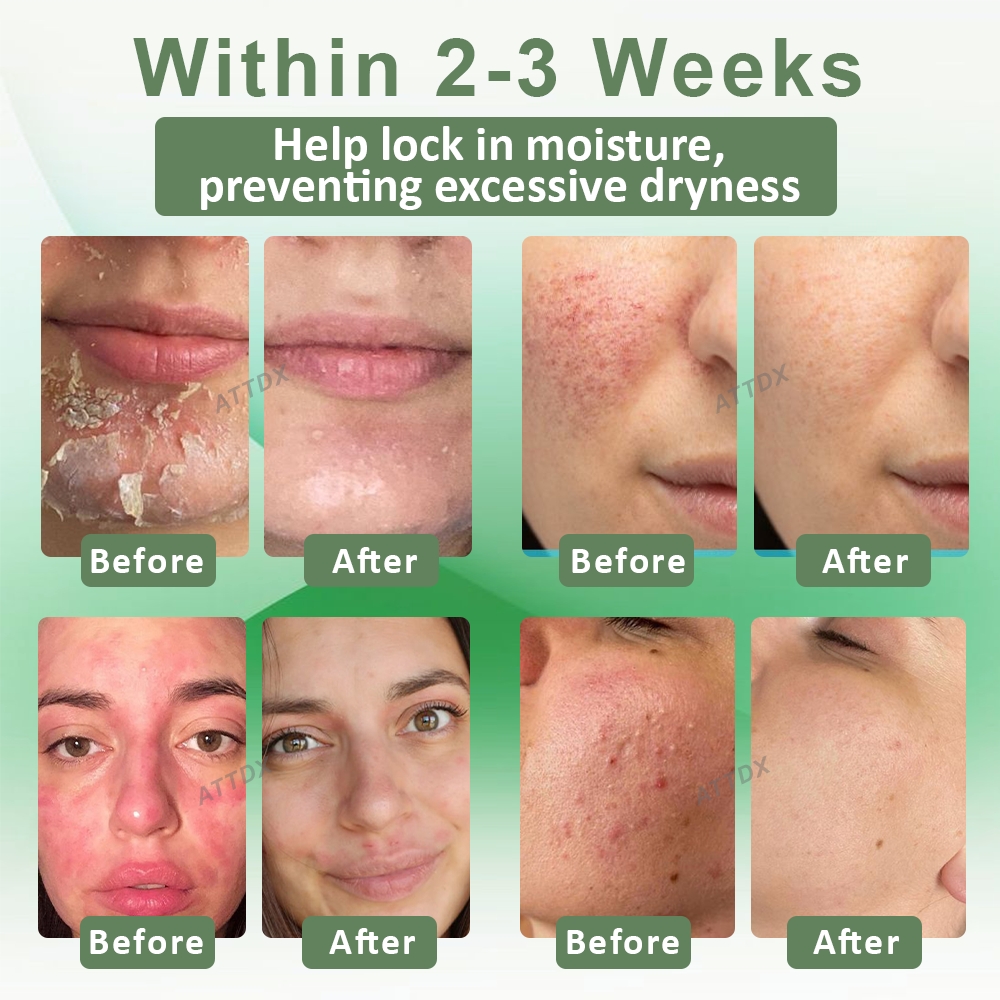 ATTDX™ Resurrection Grass Skin Soothing Herbal Cream