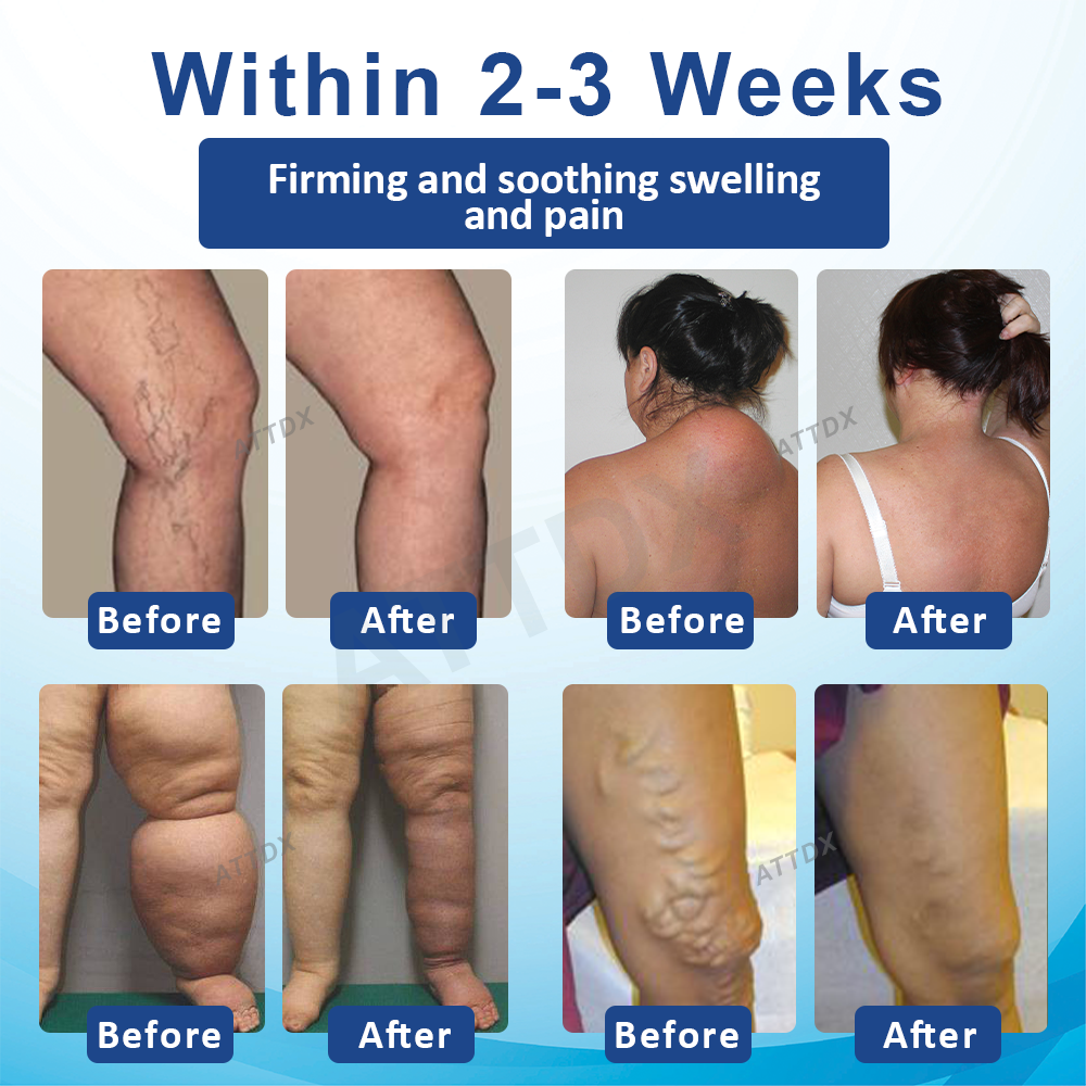 ATTDX™ SwellingEase Lymphatic Drainage Massage Cream