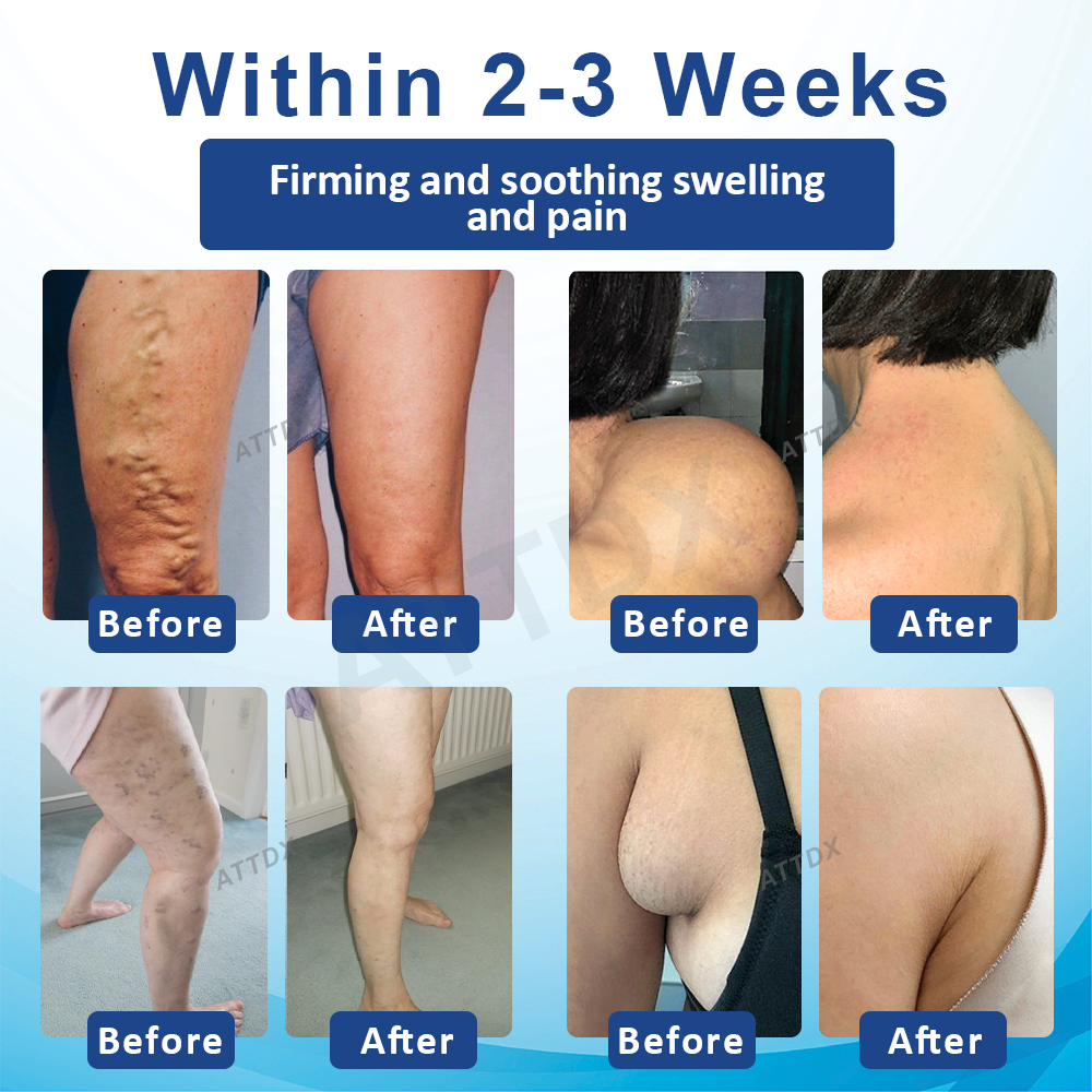 ATTDX™ SwellingEase Lymphatic Drainage Massage Cream