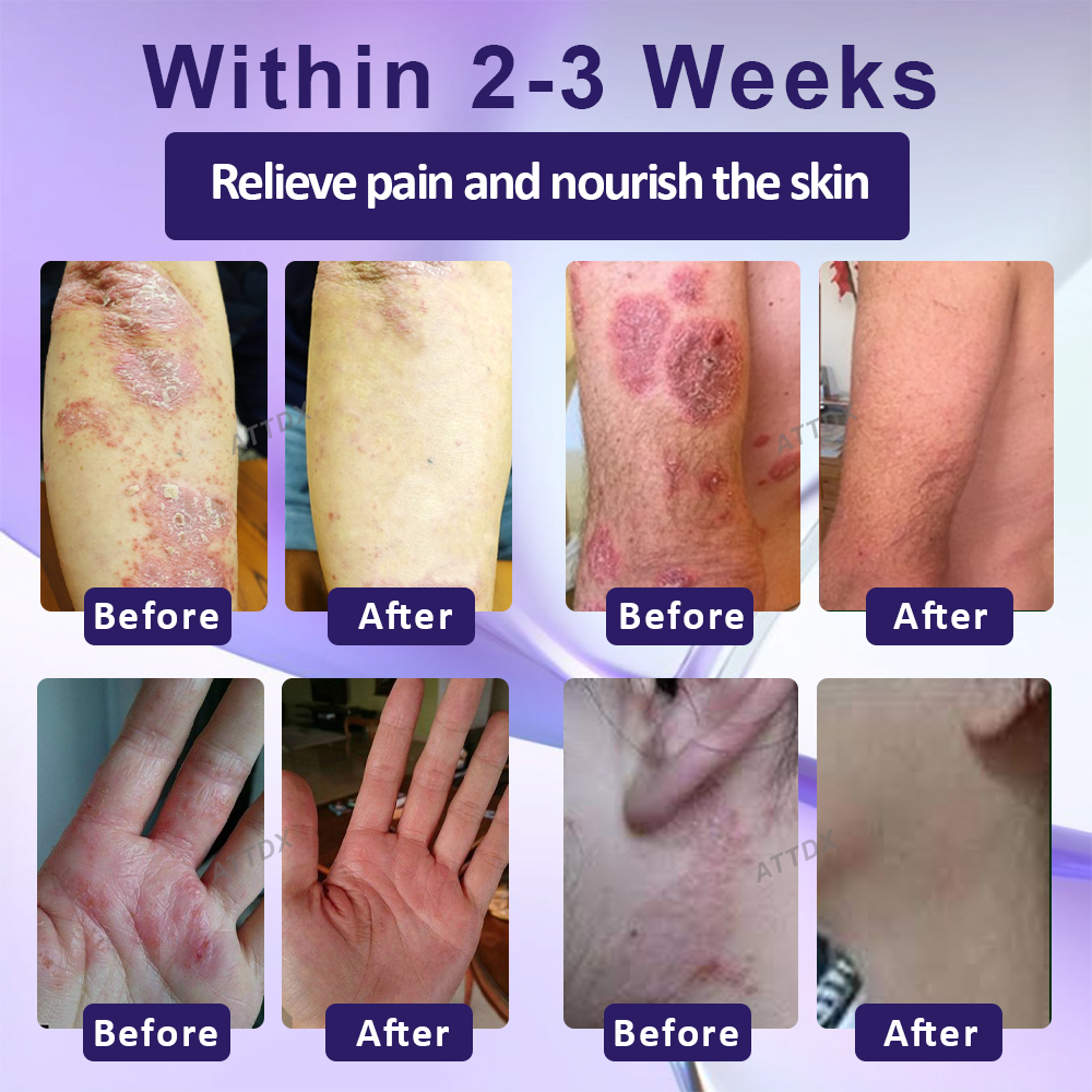 ATTDX™ Violet Soothing Skin Therapy Ointment