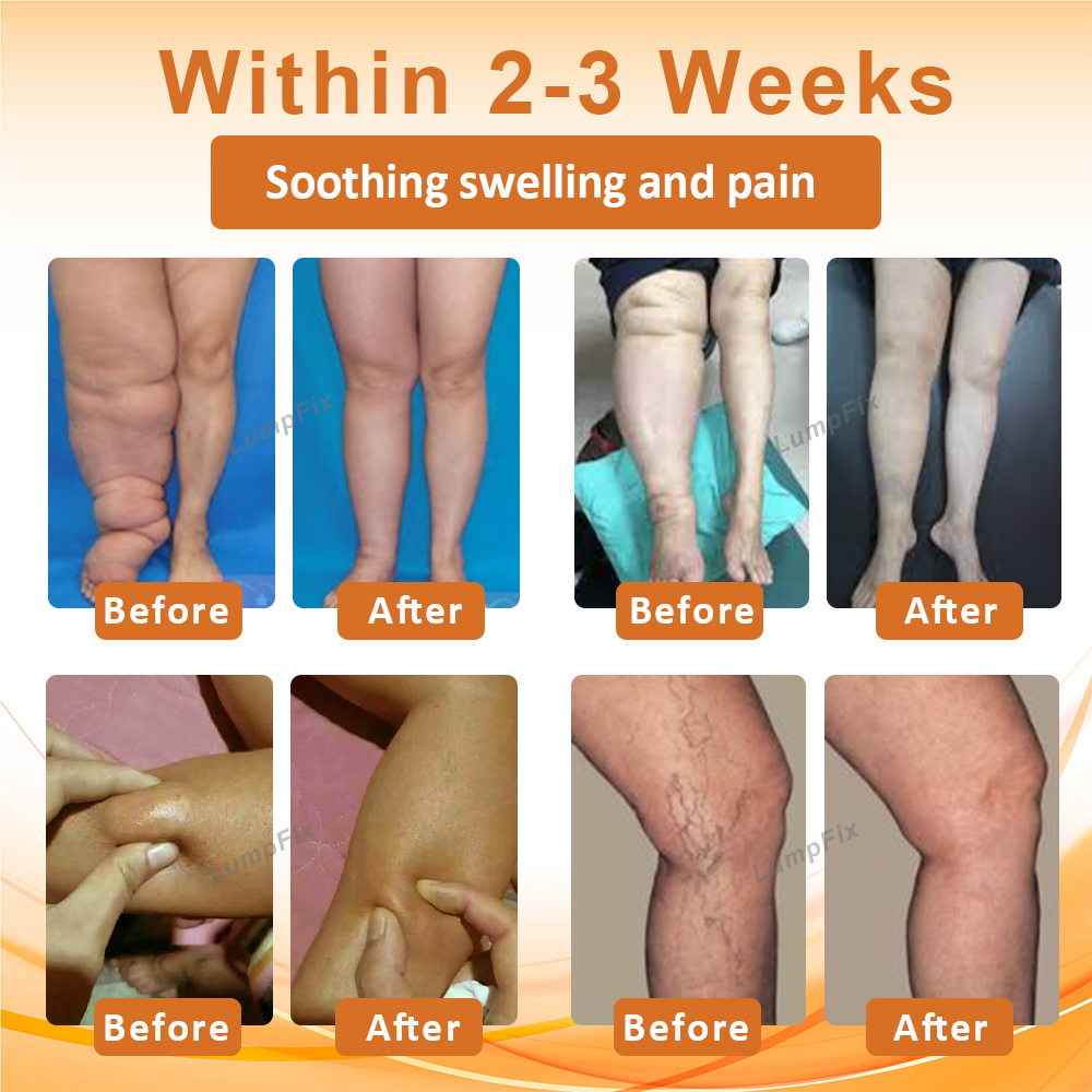 LumpFix™ Apis Venom LymphSupport Roll On