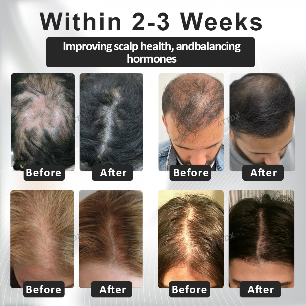 ATTDX™ Alopecia Recovery Hair Booster Roll-On