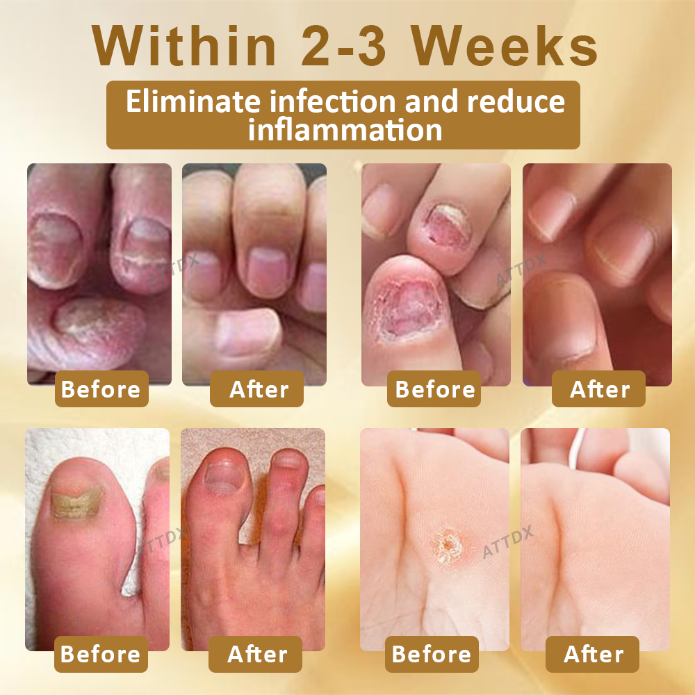 ATTDX™ AntiFungal Mellifera Venom Repair Serum