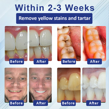 ATTDX™ Concentrated Mellifera Venom Mouth Care Toothpaste