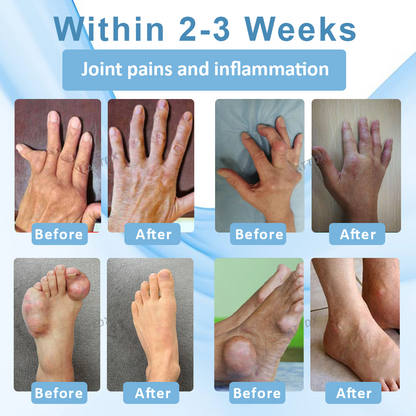 ATTDX™ Gout Soothe Herbal Joint Relief Patch