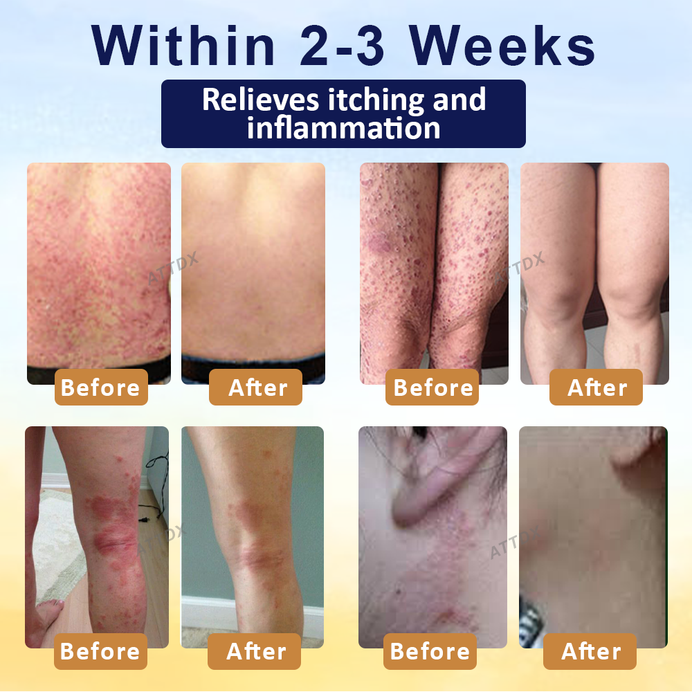 ATTDX™ PsoriasisCare Mellifera Venom Skin Healing Spray