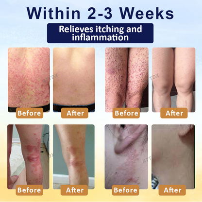 ATTDX™ PsoriasisCare Mellifera Venom Skin Healing Spray