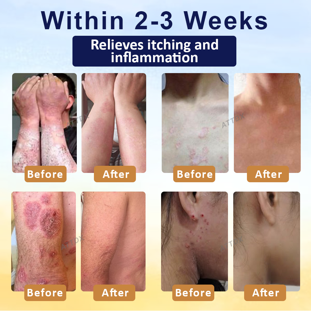 ATTDX™ PsoriasisCare Mellifera Venom Skin Healing Spray