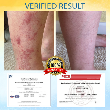 ATTDX™ PsoriasisCare Mellifera Venom Skin Healing Spray