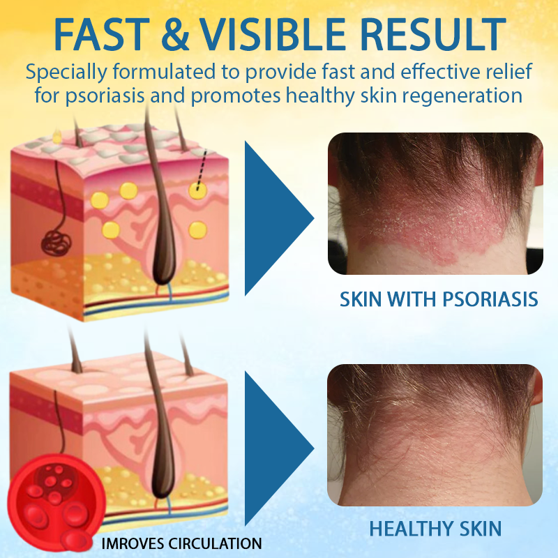 ATTDX™ PsoriasisCare Mellifera Venom Skin Healing Spray