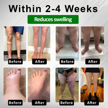 ATTDX® PuffyGone Horse Chestnut Edema Cream