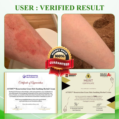 ATTDX™ Resurrection Grass Skin Soothing Herbal Cream