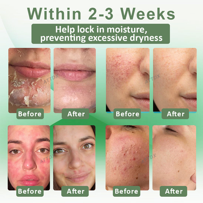 ATTDX™ Resurrection Grass Skin Soothing Herbal Cream