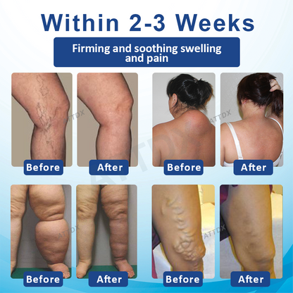 ATTDX™ SwellingEase Lymphatic Drainage Massage Cream