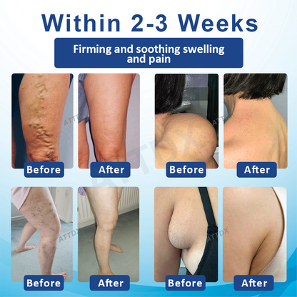 ATTDX™ SwellingEase Lymphatic Drainage Massage Cream