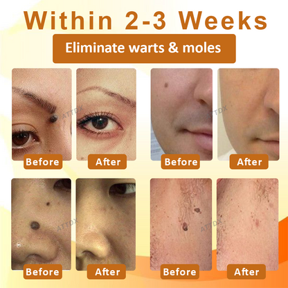 ATTDX™ Venomous Apitherapy Tag and Mole Removal Patches