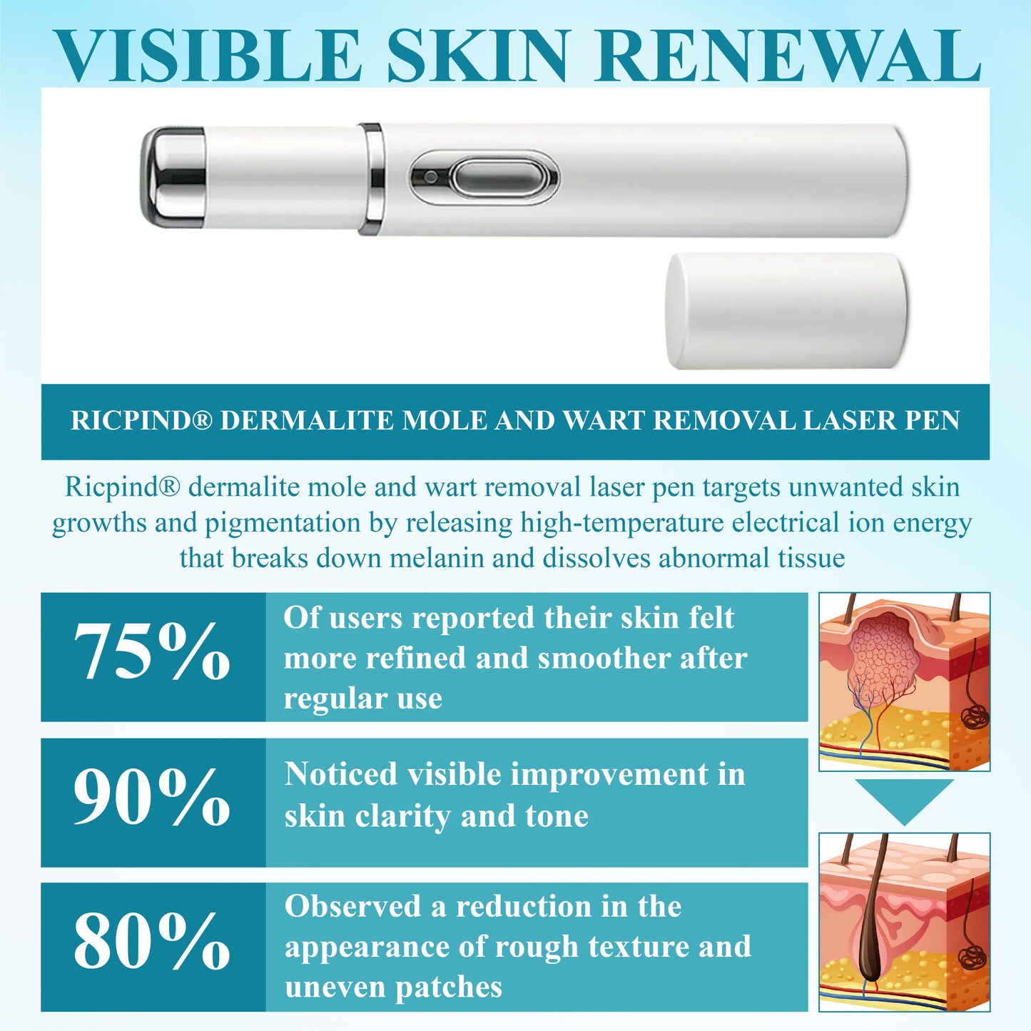 RICPIND® DermaLite Mole and Wart Removal Laser Pen