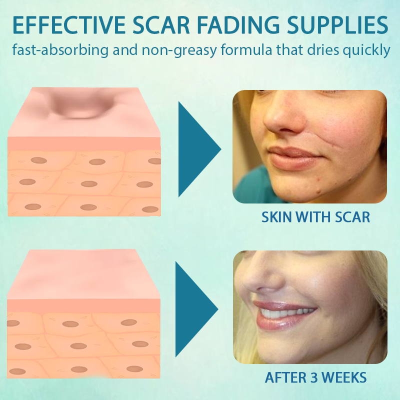 ScarEase™ Advanced SkinHealing Gel