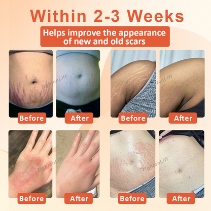 TightenLift™ SkinFirming and ScarRepair Oil